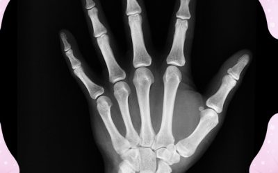 Episode #53: Holistic strategies to reverse osteoporosis