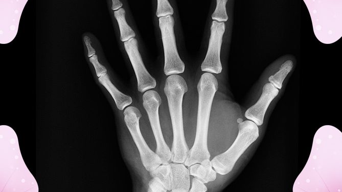 Episode #53: Holistic strategies to reverse osteoporosis